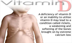 80 درصد افراد سالم جامعه کمبود ویتامین D دارند