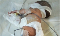 دانشگاه علوم پزشکی رفسنجان هزینه‌ جداسازی دوقلوهای زرندی را تقبل کرد