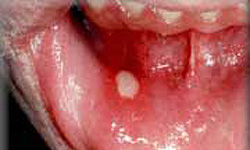 عفونت قارچی از عفونت‌های رایج در حفره دهان است