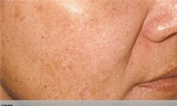 لایه‌برداری پوست بدون روش‌های دیگر درمانی عوارض شدیدی به دنبال دارد