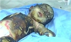 «فیلم» و «عکس» دلخراش «بدن سوخته» کودک فلسطینی