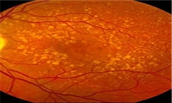 غفلت از درمان تنبلی چشم در دوران کودکی عواقب جدی را به دنبال دارد