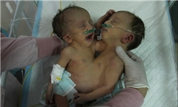 تولد دوقلوهای به هم چسبیده در بیمارستان حافظ شیراز