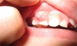 افزایش نگران کننده پوسیدگی دندان در مدارس غیرانتفاعی کهگیلویه و بویراحمد