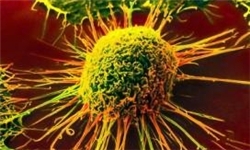 10 سرطان شایع قزوین اعلام شد