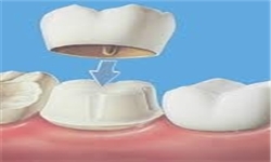 فیشورسیلنت تراپی دندان به تنهایی قادر به پیشگیری از پوسیدگی نیست
