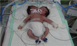 تولد نوزاد دوسر در بیمارستان دزفول