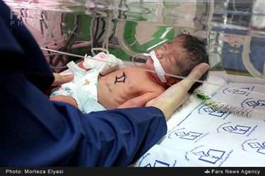 تولد نوزادان چهار قلو در زنجان