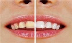 آسیب‌هایی که «جرم‌گیری» به مینای دندان وارد می‌کند