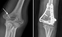 افزایش خطر مرگ زودرس با شکستگی استخوان در پیری