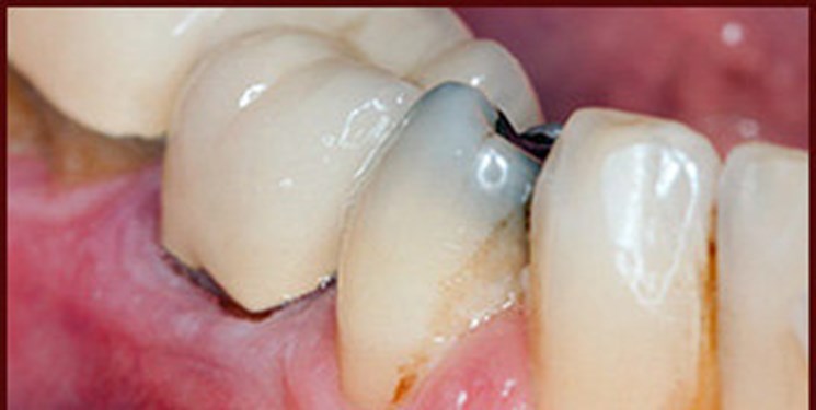 روشی برای ایمپلنت بیماران گرفتار دیابت و پوکی استخوان/ بی دندانی کامل نوعی «معلولیت» 
