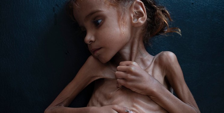 دختر بچه یمنی بالاخره از گرسنگی و ضعف جسمی جان باخت