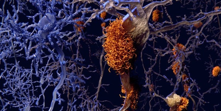 موفقیت در مدل انسانی داروی جدید آلزایمر