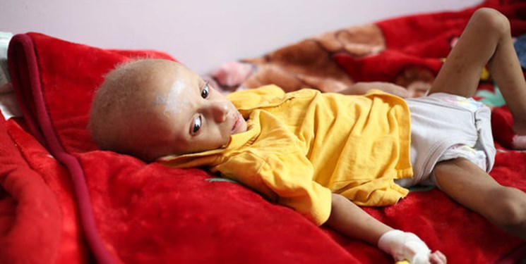 وزارت بهداشت یمن: هر 10 دقیقه یک کودک یمنی به دلیل سوء تغذیه می‌میرد