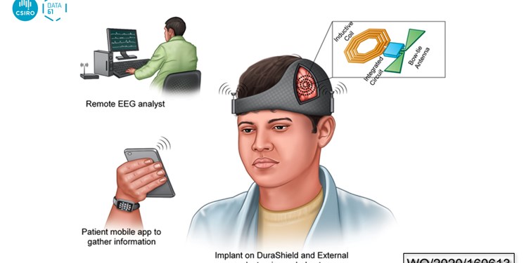 کلاه هوش مصنوعی از تشنج جلوگیری می‌کند