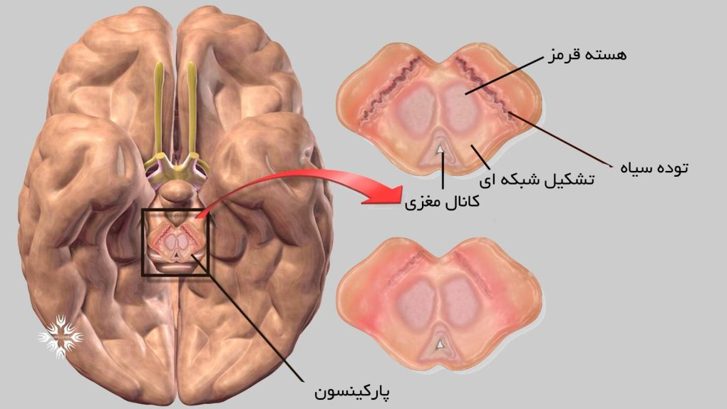 مهمترین نشانه پارکینسون 3