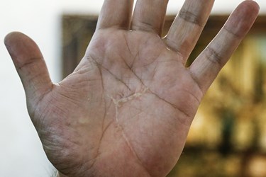 اثر جراحت شمشیردریکی از تمرین ها 