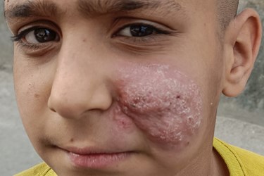 سالک، یک بیماری انگلی‌ست که شیوع و بروز آن، ریشه در بهداشت محیط دارد