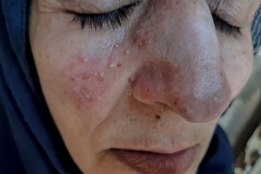سالک هیچ دارو یا واکسنی برای پیشگیری ندارد و به انواع جلدی(پوستی) و مخاطی-جلدی یا احشایی تقسیم‌بندی می‌شود