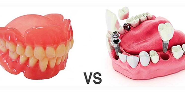 دندان مصنوعی متحرک بهتر است یا ایمپلنت؟