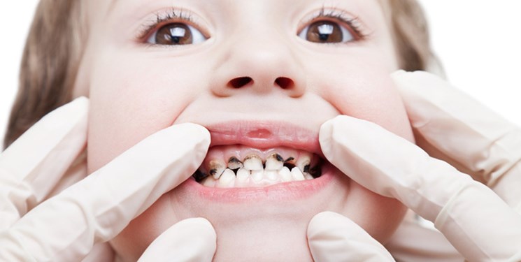 چرا دانش‌آموزان دچار پوسیدگی دندان می‌شوند؟