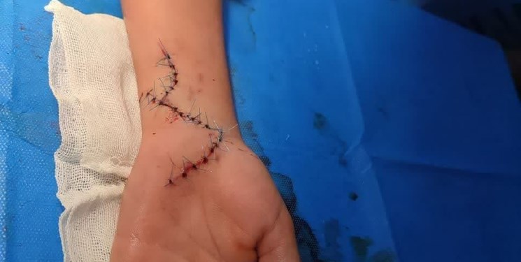 جراحی موفق ترمیم عصب دست پسر ۹ ساله در دلیجان